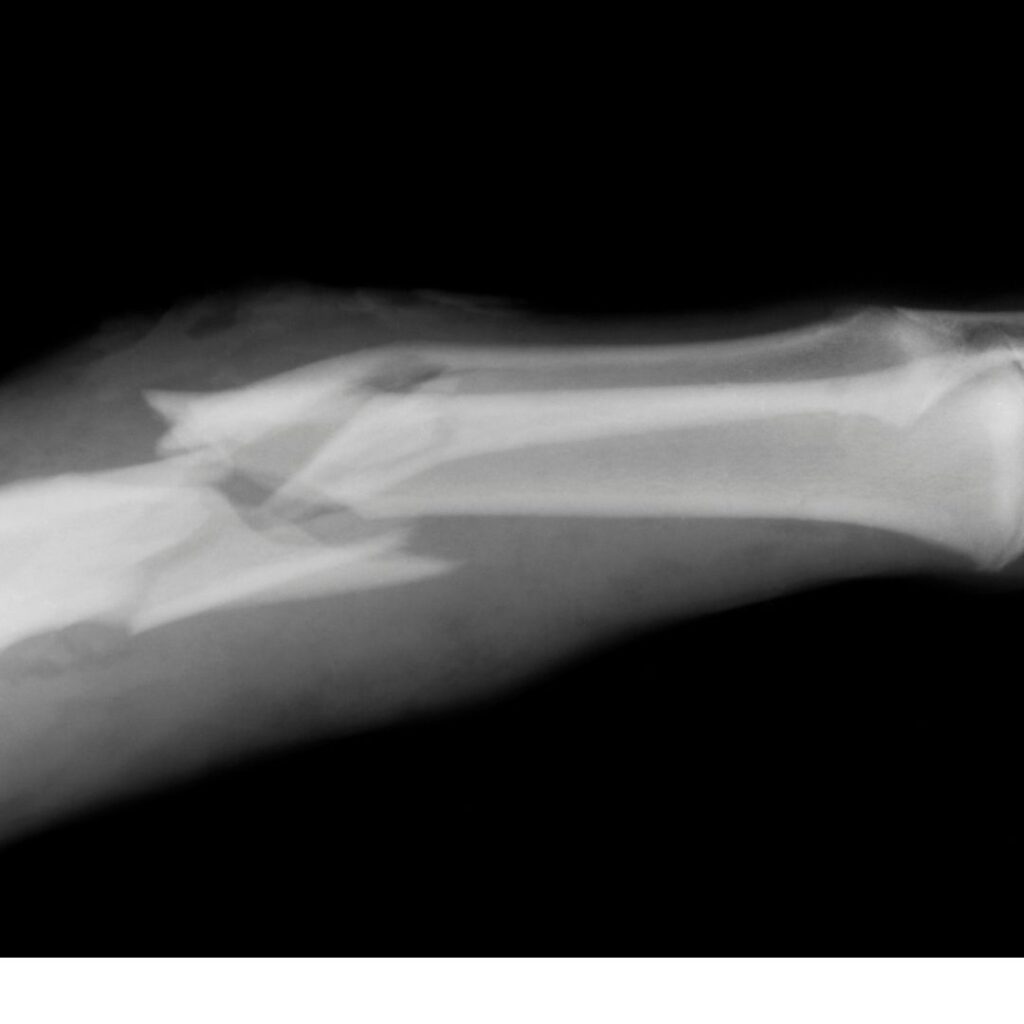 broken bone